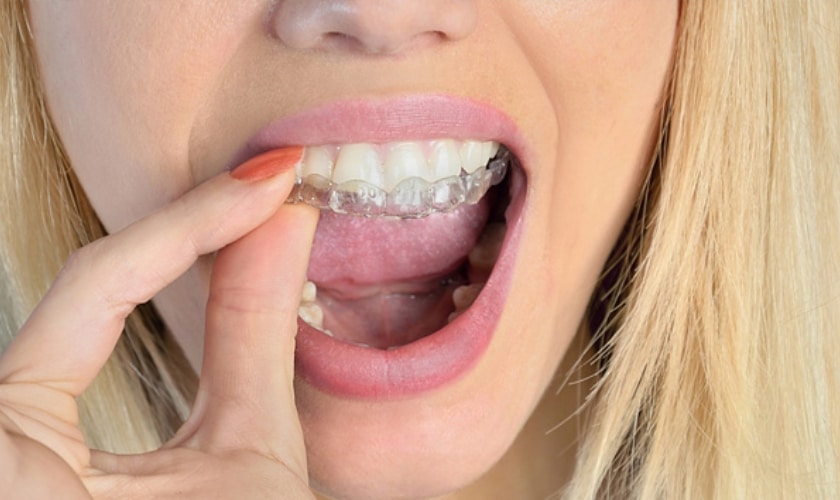 Featured image for “Straighten Your Smile with Confidence: Discover the Best Invisalign Provider in Havertown, PA”