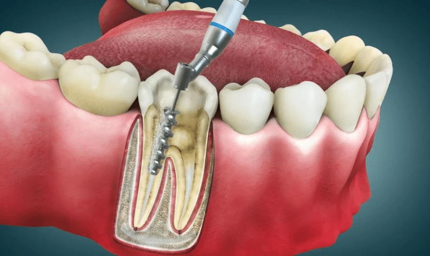 Featured image for “7 Common Signs You Need a Root Canal”