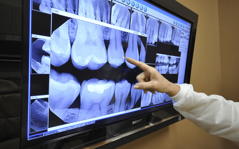 Featured image for “5 Surprising Benefits Of Digital X-Rays For Your Dental Health”