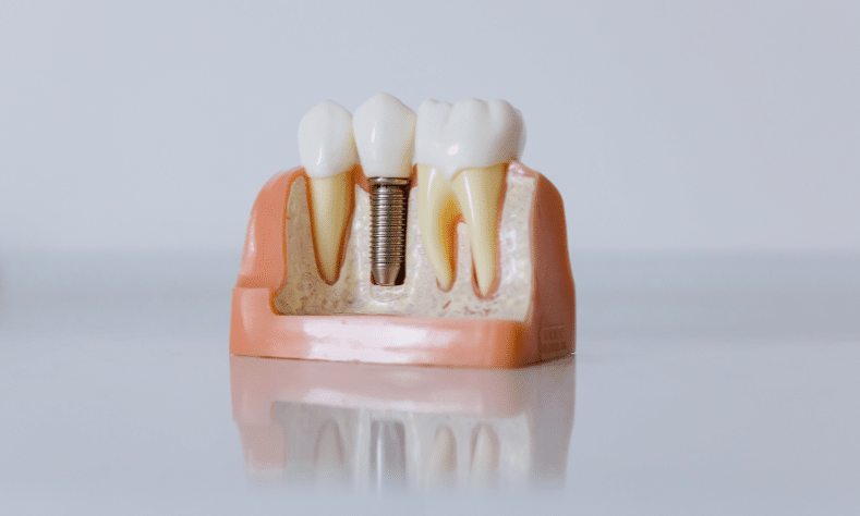 Featured image for “How To Care For Your Dental Implants: Top Five Tips For Long-Life”
