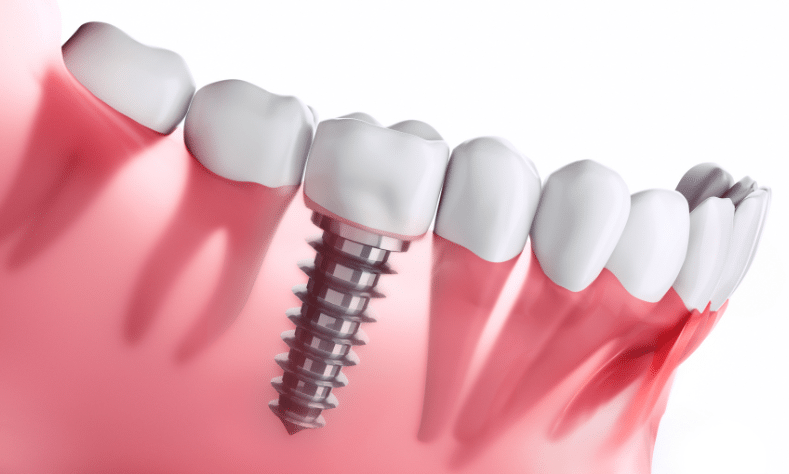 Featured image for “What To Do if You Experience Problems With Your Dental Implant?”