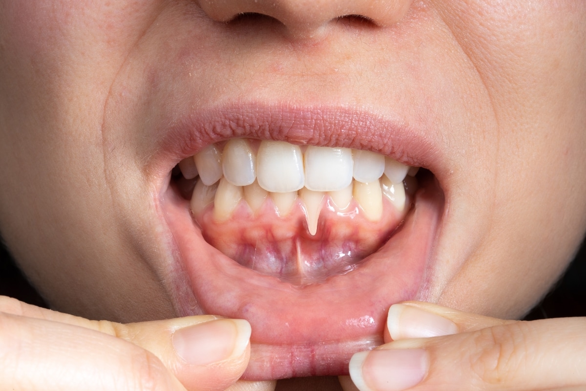 Featured image for “Gum Disease Warning Signs: When Havertown Patients Should Call Dr. Maconi”